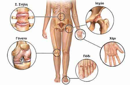 article arthritis